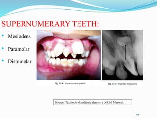 SUPERNUMERARY TEETH:
• Mesiodens
• Paramolar
• Distomolar
49
Source: Textbook of pediatric dentistry ,Nikhil Marwah.
 