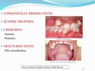  CONGENITALLY MISSING TEETH.
 ECTOPIC ERUPTION.
 CROSS BITE:
Anterior
Posterior.
 FRACTURED TEETH:
Ellis classification.
50
Source:Textbook of pediatric dentistry ,Nikhil Marwah.
 