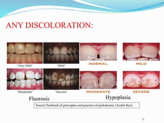 ANY DISCOLORATION:
51
Source:Textbook of principles and practice of pedodontic (Arathi Rao),
Hypoplasia.
Fluorosis
 