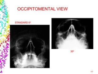 OCCIPITOMENTAL VIEW
STANDARD 00
117
300
 