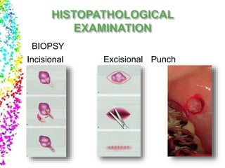 BIOPSY
Incisional Excisional Punch
 