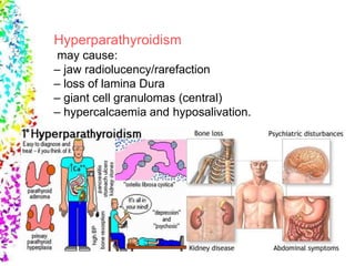 Hyperparathyroidism
may cause:
– jaw radiolucency/rarefaction
– loss of lamina Dura
– giant cell granulomas (central)
– hypercalcaemia and hyposalivation.
 