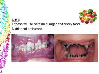 DIET:
Excessive use of refined sugar and sticky food.
Nutritional deficiency.
 