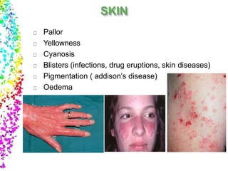 Pallor
Yellowness
Cyanosis
Blisters (infections, drug eruptions, skin diseases)
Pigmentation ( addison’s disease)
Oedema
 