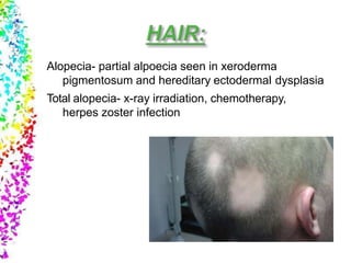 Alopecia- partial alpoecia seen in xeroderma
pigmentosum and hereditary ectodermal dysplasia
Total alopecia- x-ray irradiation, chemotherapy,
herpes zoster infection
 
