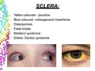 Yellow coloured - jaundice
Blue coloured –osteogenesis imperfecta
Osteoporosis
Fetal rickets
Marfan’s syndrome
Ehlers- Danlos syndrome
 
