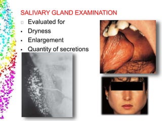 SALIVARY GLAND EXAMINATION
Evaluated for
 Dryness
 Enlargement
 Quantity of secretions
 
