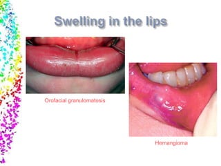 Hemangioma
Orofacial granulomatosis
 