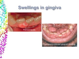 Fibrous epulis
Cyclosporin-induced gingival swelling
 