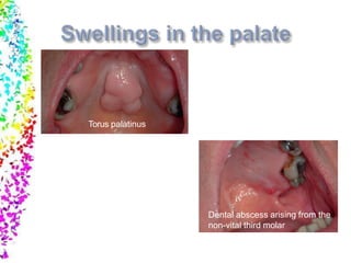 Torus palatinus
Dental abscess arising from the
non-vital third molar
 