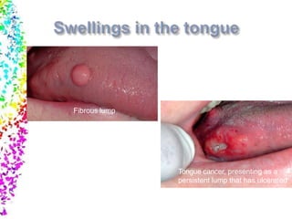 Tongue cancer, presenting as a
persistent lump that has ulcerated
Fibrous lump
 