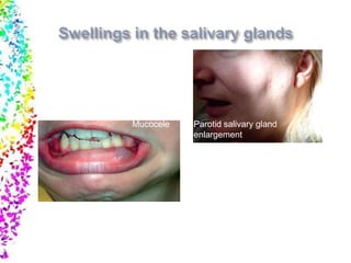 Mucocele Parotid salivary gland
enlargement
 