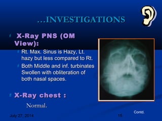 July 27, 2014 15
……INVESTIGATIONSINVESTIGATIONS
 X-Ray PNS (OMX-Ray PNS (OM
View):View):
 Rt. Max. Sinus is Hazy, Lt.Rt. Max. Sinus is Hazy, Lt.
hazy but less compared to Rt.hazy but less compared to Rt.
 Both Middle and inf. turbinatesBoth Middle and inf. turbinates
Swollen with obliteration ofSwollen with obliteration of
both nasal spaces.both nasal spaces.
 X-Ray chest :X-Ray chest :
NormalNormal..
Contd.
 