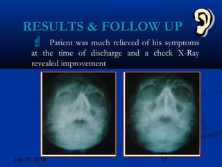 July 27, 2014 17
 Patient was much relieved of his symptomsPatient was much relieved of his symptoms
at the time of discharge and a check X-Rayat the time of discharge and a check X-Ray
revealed improvementrevealed improvement
RESULTS & FOLLOW UPRESULTS & FOLLOW UP
 
