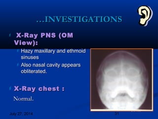 July 27, 2014 31
……INVESTIGATIONSINVESTIGATIONS
 X-Ray PNS (OMX-Ray PNS (OM
View):View):
 Hazy maxillary and ethmoidHazy maxillary and ethmoid
sinusessinuses
 Also nasal cavity appearsAlso nasal cavity appears
obliterated.obliterated.
 X-Ray chest :X-Ray chest :
NormalNormal..
Contd.
 