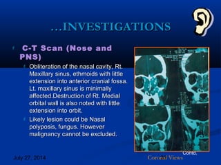 July 27, 2014 32
……INVESTIGATIONSINVESTIGATIONS
 C-T Scan (Nose andC-T Scan (Nose and
PNS)PNS)
 Obliteration of the nasal cavity, Rt.Obliteration of the nasal cavity, Rt.
Maxillary sinus, ethmoids with littleMaxillary sinus, ethmoids with little
extension into anterior cranial fossa.extension into anterior cranial fossa.
Lt. maxillary sinus is minimallyLt. maxillary sinus is minimally
affected.Destruction of Rt. Medialaffected.Destruction of Rt. Medial
orbital wall is also noted with littleorbital wall is also noted with little
extension into orbit.extension into orbit.
 Likely lesion could be NasalLikely lesion could be Nasal
polyposis, fungus. Howeverpolyposis, fungus. However
malignancy cannot be excluded.malignancy cannot be excluded.
Contd.
Coronal Views
 