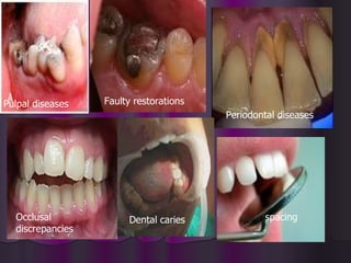 Pulpal diseases   Faulty restorations
                                        Periodontal diseases




  Occlusal             Dental caries            spacing
  discrepancies
 