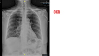CXR
 