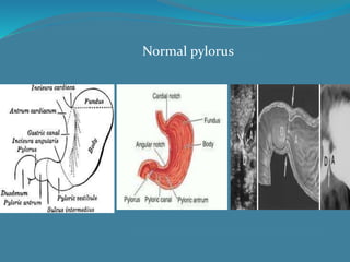 Normal pylorus
 