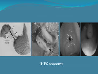 IHPS anatomy
 