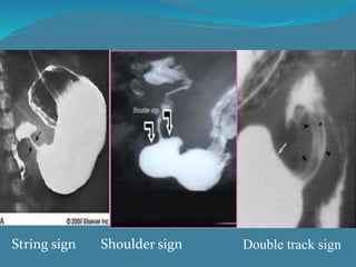 Double track signShoulder signString sign
 