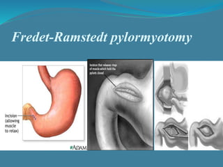 Fredet-Ramstedt pylormyotomy
 