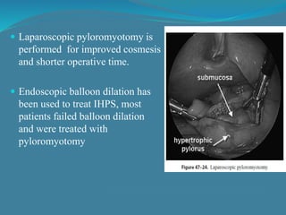  Laparoscopic pyloromyotomy is
performed for improved cosmesis
and shorter operative time.
 Endoscopic balloon dilation has
been used to treat IHPS, most
patients failed balloon dilation
and were treated with
pyloromyotomy
 