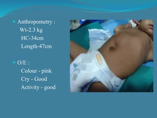  Anthropometry :
Wt-2.3 kg
HC-34cm
Length-47cm
 O/E :
Colour - pink
Cry - Good
Activity - good
 