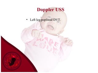 Doppler USS
• Left leg popliteal DVT.
 