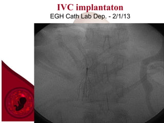 IVC implantaton
EGH Cath Lab Dep. - 2/1/13
 