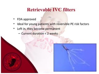 Retrievable IVC filters
• FDA approved
• Ideal for young patients with reversible PE risk factors
• Left in, they become permanent
– Current duration < 2 weeks
 