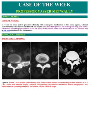 CASE OF THE WEEK
                    PROFESSOR YASSER METWALLY
CLINICAL PICTURE

CLINICAL PICTURE:

33 Years old male patient presented clinically with neurogenic claudication of the cauda equina. Clinical
examination revealed depression of the left ankle reflex. (To inspect the patient's full radiological study, click on the
attachment icon (The paper clip icon in the left pane) of the acrobat reader then double click on the attached file)
(Click here to download the attached file)

RADIOLOGICAL FINDINGS

RADIOLOGICAL FINDINGS:




Figure 1. Plain CT scan lumbar spine showing bony stenosis of the lumbar canal (antero-posterior diameter is 11.5
CM). Notice mild annular bulging, articular fact pathology (asymmetric orientation, medial osteophytosis, and
reduction of the synovial joint space). The lumbar canal is trefoil in shape.
 