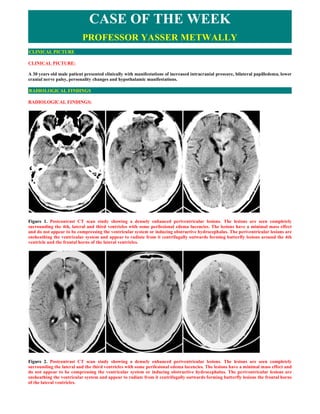 CASE OF THE WEEK
                           PROFESSOR YASSER METWALLY
CLINICAL PICTURE

CLINICAL PICTURE:

A 30 years old male patient presented clinically with manifestations of increased intracranial pressure, bilateral papilledema, lower
cranial nerve palsy, personality changes and hypothalamic manifestations.

RADIOLOGICAL FINDINGS

RADIOLOGICAL FINDINGS:




Figure 1. Postcontrast CT scan study showing a densely enhanced periventricular lesions. The lesions are seen completely
surrounding the 4th, lateral and third ventricles with some perilesional edema lucencies. The lesions have a minimal mass effect
and do not appear to be compressing the ventricular system or inducing obstructive hydrocephalus. The periventricular lesions are
ensheathing the ventricular system and appear to radiate from it centrifugally outwards forming butterfly lesions around the 4th
ventricle and the frontal horns of the lateral ventricles.




Figure 2. Postcontrast CT scan study showing a densely enhanced periventricular lesions. The lesions are seen completely
surrounding the lateral and the third ventricles with some perilesional edema lucencies. The lesions have a minimal mass effect and
do not appear to be compressing the ventricular system or inducing obstructive hydrocephalus. The periventricular lesions are
ensheathing the ventricular system and appear to radiate from it centrifugally outwards forming butterfly lesions the frontal horns
of the lateral ventricles.
 