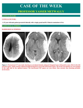 CASE OF THE WEEK
                           PROFESSOR YASSER METWALLY
CLINICAL PICTURE

CLINICAL PICTURE:

 A 32 years old male patient presented clinically with a single grand mal fit. Clinical examination is free.

RADIOLOGICAL FINDINGS

RADIOLOGICAL FINDINGS:




Figure 1. Postcontrast CT scan study showing an extradural densely enhanced elongated mass with positive mass effect in the left
parietal region. Anther densely enhanced epidural deposit is seen in the left frontal region. The brain convolutions are seen pushed
to the right side by the epidural masses. The interfrontal CSF spaces are seen denser than normal, thus denoting probable
involvement.
 