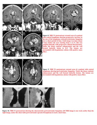 Case record...Epidural secondary CNS lymphoma