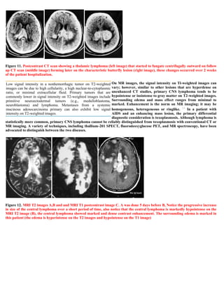Case record...Epidural secondary CNS lymphoma