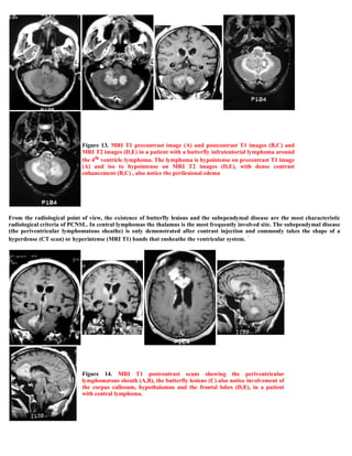 Case record...Epidural secondary CNS lymphoma