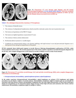 Case record...Epidural secondary CNS lymphoma
