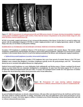 Case record...Epidural secondary CNS lymphoma