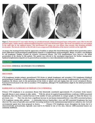 Case record...Epidural secondary CNS lymphoma