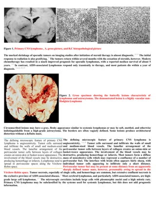 Case record...Epidural secondary CNS lymphoma