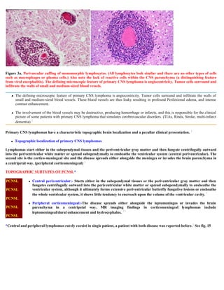 Case record...Epidural secondary CNS lymphoma