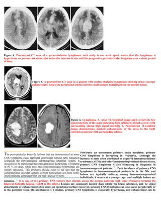 Case record...Epidural secondary CNS lymphoma