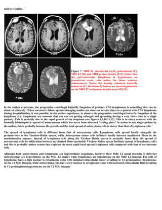 Case record...Epidural secondary CNS lymphoma