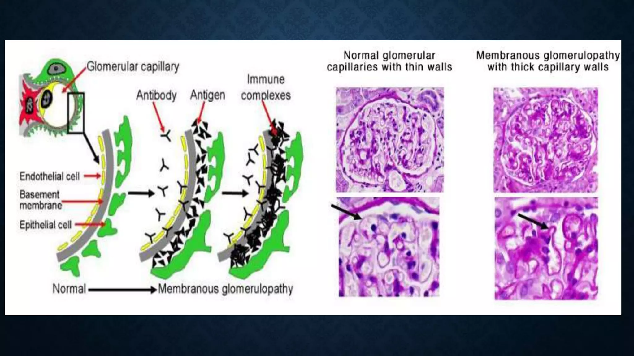 Case Membranous Nephropathy PPTX case-membranous-nephropathy-pptx