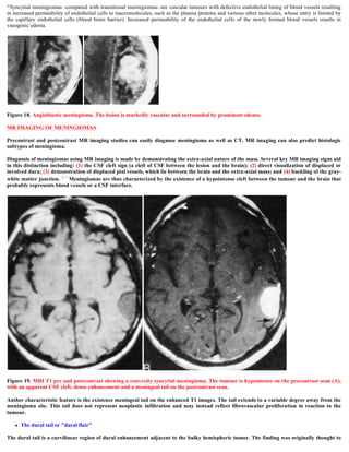 *Syncytial meningiomas -compared with transitional meningiomas- are vascular tumours with defective endothelial lining of blood vessels resulting
in increased permeability of endothelial cells to macromolecules, such as the plasma proteins and various other molecules, whose entry is limited by
the capillary endothelial cells (blood brain barrier). Increased permeability of the endothelial cells of the newly formed blood vessels results in
vasogenic edema.
Figure 18. Angioblastic meningioma. The lesion is markedly vascular and surrounded by prominent edema.
MR IMAGING OF MENINGIOMAS
Precontrast and postcontrast MR imaging studies can easily diagnose meningioma as well as CT. MR imaging can also predict histologic
subtypes of meningioma.
Diagnosis of meningiomas using MR imaging is made by demonstrating the extra-axial nature of the mass. Several key MR imaging signs aid
in this distinction including: (1) the CSF cleft sign (a cleft of CSF between the lesion and the brain); (2) direct visualization of displaced or
involved dura; (3) demonstration of displaced pial vessels, which lie between the brain and the extra-axial mass; and (4) buckling of the gray-
white matter junction. 8,9 Meningiomas are thus characterized by the existence of a hypointense cleft between the tumour and the brain that
probably represents blood vessels or a CSF interface.
Figure 19. MRI T1 pre and postcontrast showing a convexity syncytial meningioma. The tumour is hypointense on the precontrast scan (A),
with an apparent CSF cleft, dense enhancement and a meningeal tail on the postcontrast scan.
Anther characteristic feature is the existence meningeal tail on the enhanced T1 images. The tail extends to a variable degree away from the
meningioma site. This tail does not represent neoplastic infiltration and may instead reflect fibrovascular proliferation in reaction to the
tumour.
 The dural tail or "dural flair"
The dural tail is a curvilinear region of dural enhancement adjacent to the bulky hemispheric tumor. The finding was originally thought to
 