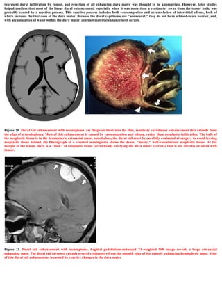 represent dural infiltration by tumor, and resection of all enhancing dura mater was thought to be appropriate. However, later studies
helped confirm that most of the linear dural enhancement, especially when it was more than a centimeter away from the tumor bulk, was
probably caused by a reactive process. This reactive process includes both vasocongestion and accumulation of interstitial edema, both of
which increase the thickness of the dura mater. Because the dural capillaries are "nonneural," they do not form a blood-brain barrier, and,
with accumulation of water within the dura mater, contrast material enhancement occurs.
Figure 20. Dural tail enhancement with meningioma. (a) Diagram illustrates the thin, relatively curvilinear enhancement that extends from
the edge of a meningioma. Most of this enhancement is caused by vasocongestion and edema, rather than neoplastic infiltration. The bulk of
the neoplastic tissue is in the hemispheric extraaxial mass; nonetheless, the dural tail must be carefully evaluated at surgery to avoid leaving
neoplastic tissue behind. (b) Photograph of a resected meningioma shows the dense, "meaty," well-vascularized neoplastic tissue. At the
margin of the lesion, there is a "claw" of neoplastic tissue (arrowhead) overlying the dura mater (arrows) that is not directly involved with
tumor.
Figure 21. Dural tail enhancement with meningioma. Sagittal gadolinium-enhanced T1-weighted MR image reveals a large extraaxial
enhancing mass. The dural tail (arrows) extends several centimeters from the smooth edge of the densely enhancing hemispheric mass. Most
of this dural tail enhancement is caused by reactive changes in the dura mater
 