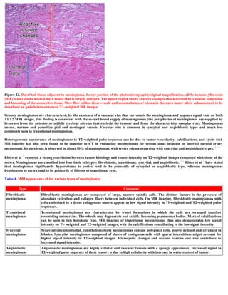 Figure 22. Dural tail tissue adjacent to meningioma. Lower portion of the photomicrograph (original magnification, x250; hematoxylin-eosin
[H-E] stain) shows normal dura mater that is largely collagen. The upper region shows reactive changes characterized by vascular congestion
and loosening of the connective tissue. Slow flow within these vessels and accumulation of edema in the dura mater allow enhancement to be
visualized on gadolinium-enhanced T1-weighted MR images.
Grossly meningiomas are characterized, by the existence of a vascular rim that surrounds the meningioma and appears signal void on both
T1,T2 MRI images, this finding is consistent with the overall blood supply of meningiomas (the peripheries of meningiomas are supplied by
branches from the anterior or middle cerebral arteries that encircle the tumour and form the characteristic vascular rim). Meningiomas
encase, narrow and parasitize pial and meningeal vessels. Vascular rim is common in syncytial and angioblastic types and much less
commonly seen in transitional meningiomas.
Heterogeneous appearance of meningiomas in T2-weighted pulse sequence can be due to tumor vascularity, calcifications, and cystic foci.
MR imaging has also been found to be superior to CT in evaluating meningiomas for venous sinus invasion or internal carotid artery
encasement. Brain edema is observed in about 50% of meningiomas, with severe edema occurring with syncytial and angioblastic types. 5
Elster et al 5 reported a strong correlation between tumor histology and tumor intensity on T2-weighted images compared with those of the
cortex. Meningiomas are classified into four basic subtypes: fibroblastic, transitional, syncytial, and angioblastic. 4,6 Elster et al 5 have stated
that meningiomas significantly hyperintense to cortex tend to be primarily of syncytial or angioblastic type, whereas meningiomas
hypointense to cortex tend to be primarily of fibrous or transitional type.
Table 4. MRI appearance of the various types of meningiomas
Type Comment
Fibroblastic
meningiomas
Fibroblastic meningiomas are composed of large, narrow spindle cells. The distinct feature is the presence of
abundant reticulum and collagen fibers between individual cells. On MR imaging, fibroblastic meningiomas with
cells embedded in a dense collagenous matrix appear as low signal intensity in Tl-weighted and T2-weighted pulse
sequences.
Transitional
meningiomas
Transitional meningiomas are characterized by whorl formations in which the cells are wrapped together
resembling onion skins. The whorls may degenerate and calcify, becoming psammoma bodies. Marked calcifications
can be seen in this histologic type. MR imaging of transitional meningiomas thus also demonstrates low signal
intensity on Tl- weighted and T2-weighted images, with the calcifications contributing to the low signal intensity.
Syncytial
meningiomas
Syncytial (meningothelial, endotheliomatous) meningiomas contain polygonal cells, poorly defined and arranged in
lobules. Syncytial meningiomas composed of sheets of contiguous cells with sparse interstitium might account for
higher signal intensity in T2-weighted images. Microcystic changes and nuclear vesicles can also contribute to
increased signal intensity.
Angioblastic
meningiomas
Angioblastic meningiomas are highly cellular and vascular tumors with a spongy appearance. Increased signal in
T2-weighted pulse sequence of these tumors is due to high cellularity with increase in water content of tumor.
 