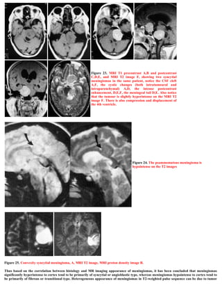 Figure 25. Convexity syncytial meningioma, A, MRI T2 image, MRI proton density image B.
Thus based on the correlation between histology and MR imaging appearance of meningiomas, it has been concluded that meningiomas
significantly hyperintense to cortex tend to be primarily of syncytial or angioblastic type, whereas meningiomas hypointense to cortex tend to
be primarily of fibrous or transitional type. Heterogeneous appearance of meningiomas in T2-weighted pulse sequence can be due to tumor
Figure 23. MRI T1 precontrast A,B and postcontrast
C,D,E, and MRI T2 image F, showing two syncytial
meningiomas in the same patient, notice the CSF cleft
A,F, the cystic changes (both intratumoural and
intraparenchymal) A,D, the intense postcontrast
enhancement, D,E,F, the meningeal tail D,E. Also notice
that the tumour is slightly hyperintense on the MRI T2
image F. There is also compression and displacement of
the 4th ventricle.
Figure 24. The psammomatous meningioma is
hypointense on the T2 images
 