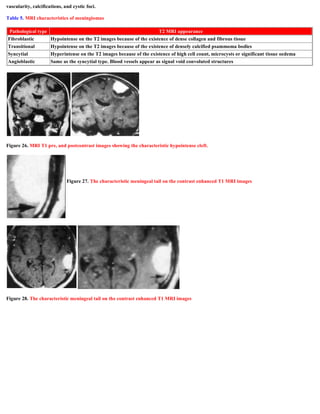 vascularity, calcifications, and cystic foci.
Table 5. MRI characteristics of meningiomas
Figure 26. MRI T1 pre, and postcontrast images showing the characteristic hypointense cleft.
Figure 28. The characteristic meningeal tail on the contrast enhanced T1 MRI images
Pathological type T2 MRI appearance
Fibroblastic Hypointense on the T2 images because of the existence of dense collagen and fibrous tissue
Transitional Hypointense on the T2 images because of the existence of densely calcified psammoma bodies
Syncytial Hyperintense on the T2 images because of the existence of high cell count, microcysts or significant tissue oedema
Angioblastic Same as the syncytial type. Blood vessels appear as signal void convoluted structures
 
 
Figure 27. The characteristic meningeal tail on the contrast enhanced T1 MRI images
 